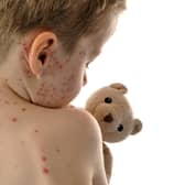 Measles causes a red blotchy rash to spread across the body (Photo: Adobe)