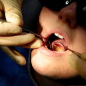 There were almost 100 hospital admissions in Bassetlaw to remove children's decaying teeth last year
