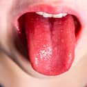 A child showing the 'strawberry tongue' symptom of scarlet fever