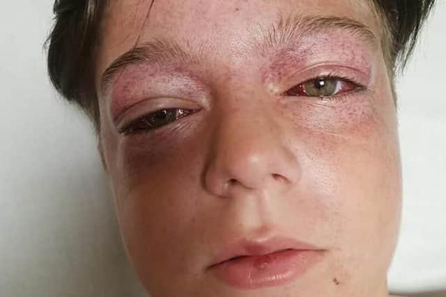 Tyler Broome has been left seriously ill after the incident