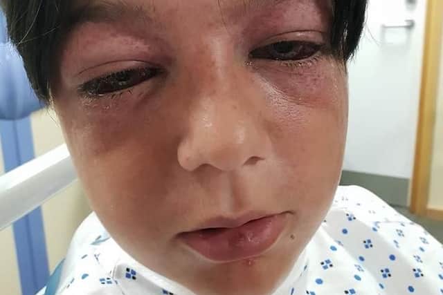 He suffered possible damage to his brain and vision and with bulging eyes