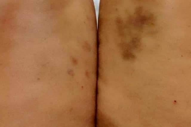 Laura was left with bloody legs after the liver disease made her scratch and bleed